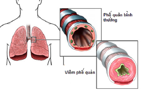 Cảnh báo: 4 NGUYÊN NHÂN GÂY VIÊM PHẾ QUẢN CẤP mà bạn không thể bỏ qua!